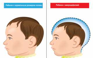 Олигофрения