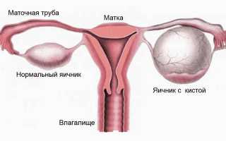 Киста яичника