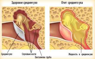 Воспаление среднего уха (средний отит)