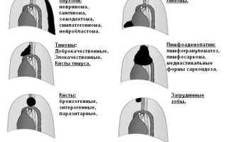 Болезнь непроходимости пищевода – как распознать и как лечить?