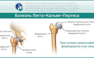 Болезнь Пертеса