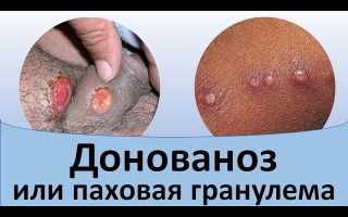 Паховая гранулёма (донованоз)