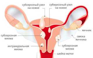 Фиброма матки