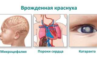 Краснуха у детей: причины, симптомы, лечение и профилактика