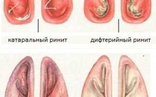 Вазомоторный ринит