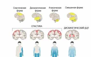 Детский церебральный паралич (ДЦП)
