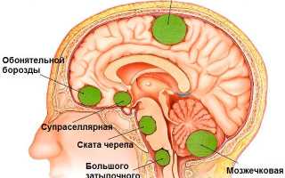 Опухоль головного мозга
