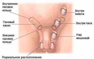 Крипторхизм
