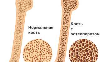 Остеопороз