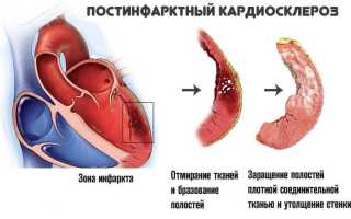 Кардиосклероз