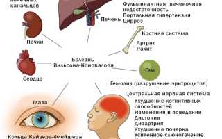 Болезнь Вильсона-Коновалова