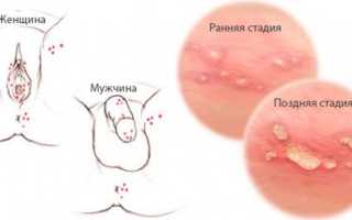 Генитальный герпес
