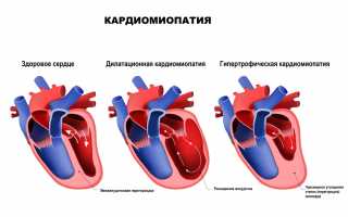 Кардиомиопатия