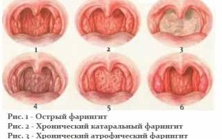 Фарингит