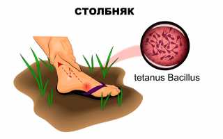 Столбняк