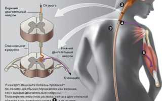 Боковой амиотрофический склероз (БАС)