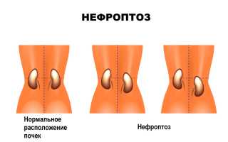 Опущение почки (Нефроптоз)