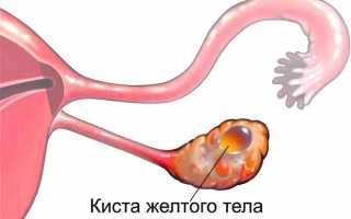 9 факторов, предрасполагающих к образованию кисты жёлтого тела