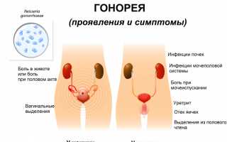 Гонорея