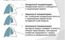 В чем опасность пневмоторакса — скопления воздуха в плевральной полости?