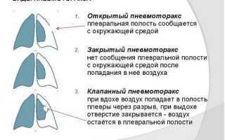 В чем опасность пневмоторакса — скопления воздуха в плевральной полости?