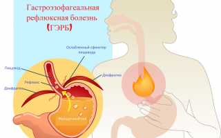 Диспепсия