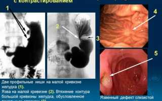 Симптомы и диагностика язвы желудка: как выявить заболевание