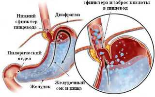 Почему происходит заброс желчи в пищевод и как это вылечить?