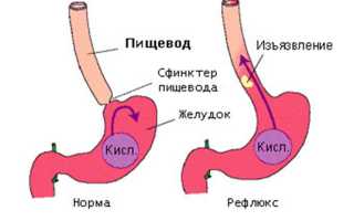 Врач-терапевт о дуоденогастральном рефлюксе: от причин до современных методов лечения и профилактики