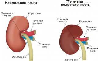 Хроническая почечная недостаточность