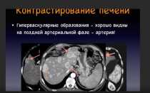 Причины появления гиперваскулярного образования печени