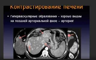 Причины появления гиперваскулярного образования печени