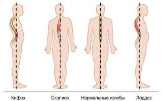 Искривление позвоночника