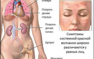 Красная волчанка