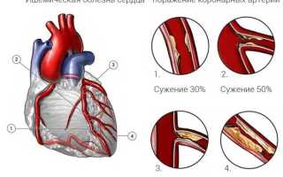 Ишемическая болезнь сердца (ИБС)