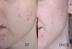 Базирон АС Базирон АС - гель для лечения угревой сыпи