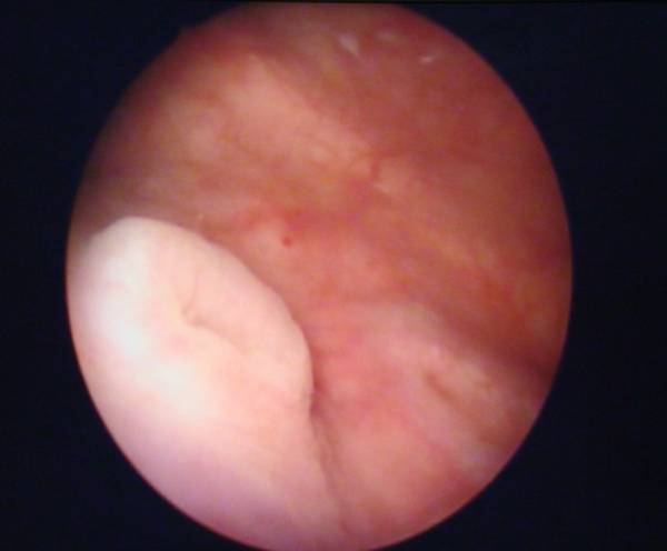 Цистоскопическая картина лейкоплакии мочевого пузыря
