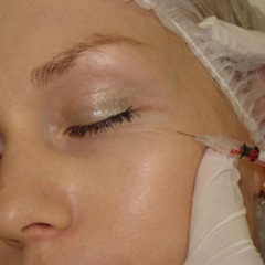 Диспорт Инъекции Диспорт, разглаживающие морщины