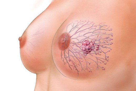 Симптомы рака молочной железы