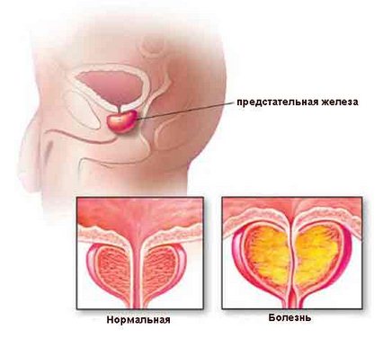 Рак предстательной железы