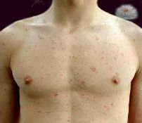 Розовый лишай - проявление заболевания