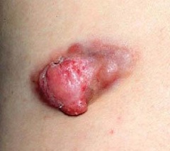 Образование опухоли - типичный симптом саркомы