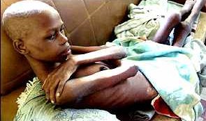 Болеющий СПИДом ребенок