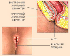 Трещина прямой кишки