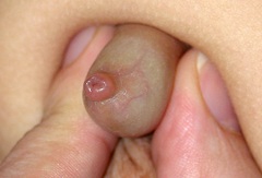 Фимоз у детей