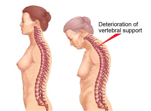 Болезнь Бехтерева