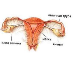 Функциональная киста яичника