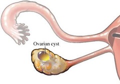 Фолликулярная киста - опухоль яичника