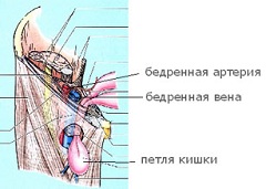 Бедренная грыжа - опухолевидное образование в области бедра