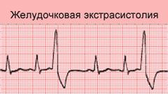 При назначении лечения экстрасистолии учитывают форму и локализацию заболевания